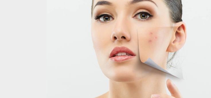 Face Acne Treatment